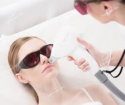 Лазерна епіляція верхня губа