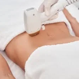 Лазерна епіляція біла лінія живота