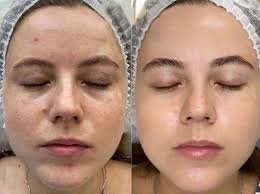 Пілінг PRX-T33 + маска в подарунок