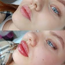 Аугментація губ