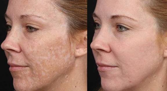 Пілінг Коєвий