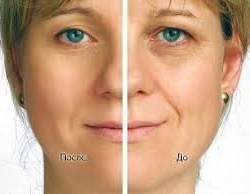 Мезоліфтинг ДМАЄ