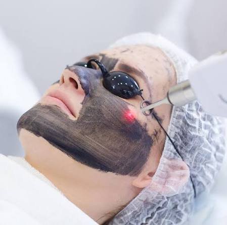 Карбоновий пілінг