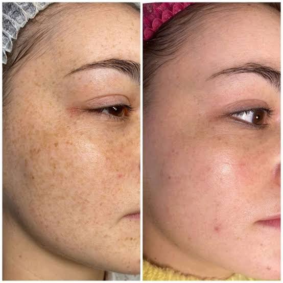 Комплекс "проти Пігментаціі"