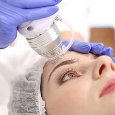 Фракційний RF ліфтинг мікроголчастий обличчя