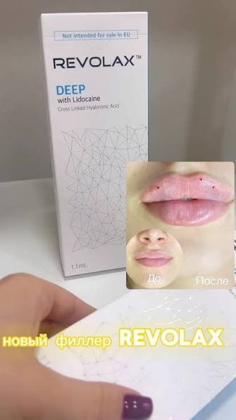 Об'єм губ (аугментація губ) препарат Revolax