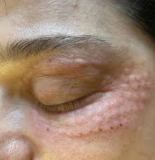 Мезотерапія орбітальноі зони (очі) (смарт4дерма)