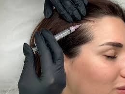 Мезотерапія шкіри голови