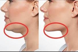 Ліполітики (шия, обличчя)