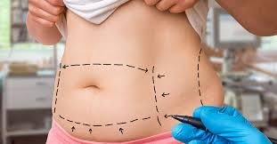 Ліполітики тіло (вартість за розмір ладоні 2,5мл)