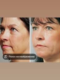 Біоревіталізація ( Kiara Reju з полінуеклідами сяєння, зволоження, відновлення)