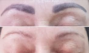 Лазерне видалення брів, тату, губ, стрілок